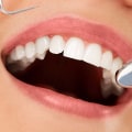 Understanding Dental Jargon: How Do Dentists Name Teeth?