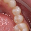 Can a Dentist Fix a Permanent Retainer?