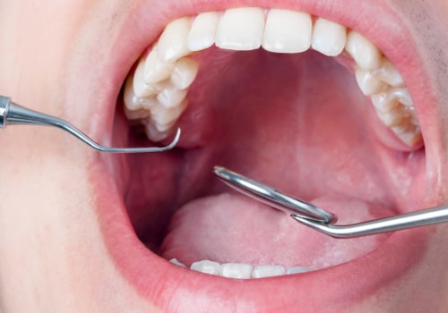 Do Orthodontists Remove Wisdom Teeth? Expert Advice on the Pros and Cons